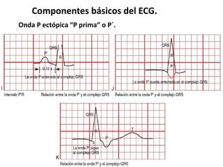 Componentes básicos del ECG.
Onda P ectópica “P prima” o P´.
 