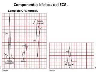 Componentes básicos del ECG.
Complejo QRS normal.
 