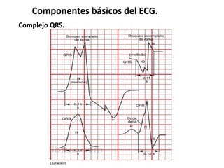 Componentes básicos del ECG.
Complejo QRS.
 