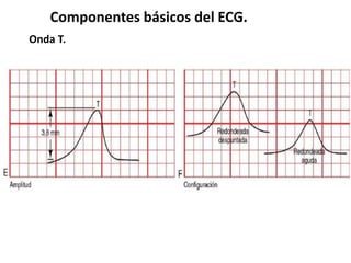 Componentes básicos del ECG.
Onda T.
 