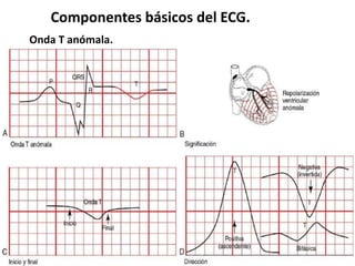 Componentes básicos del ECG.
Onda T anómala.
 