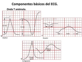Componentes básicos del ECG.
Onda T anómala.
 