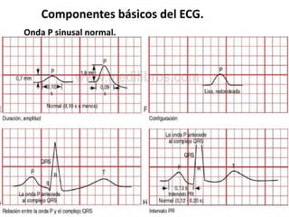 Componentes básicos del ECG.
Onda P sinusal normal.
 