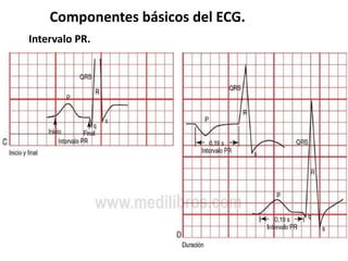 Componentes básicos del ECG.
Intervalo PR.
 