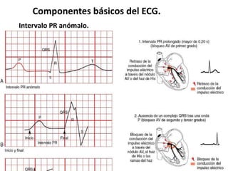 Componentes básicos del ECG.
Intervalo PR anómalo.
Vías accesorias AV.
 