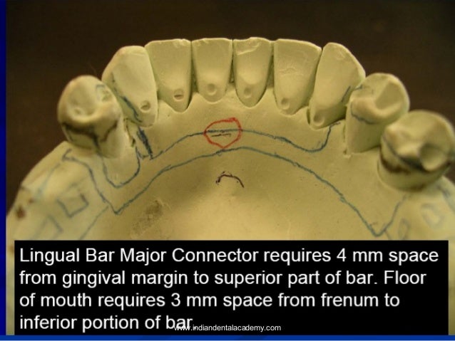 Role of component parts of cast partial dentures /dental courses
