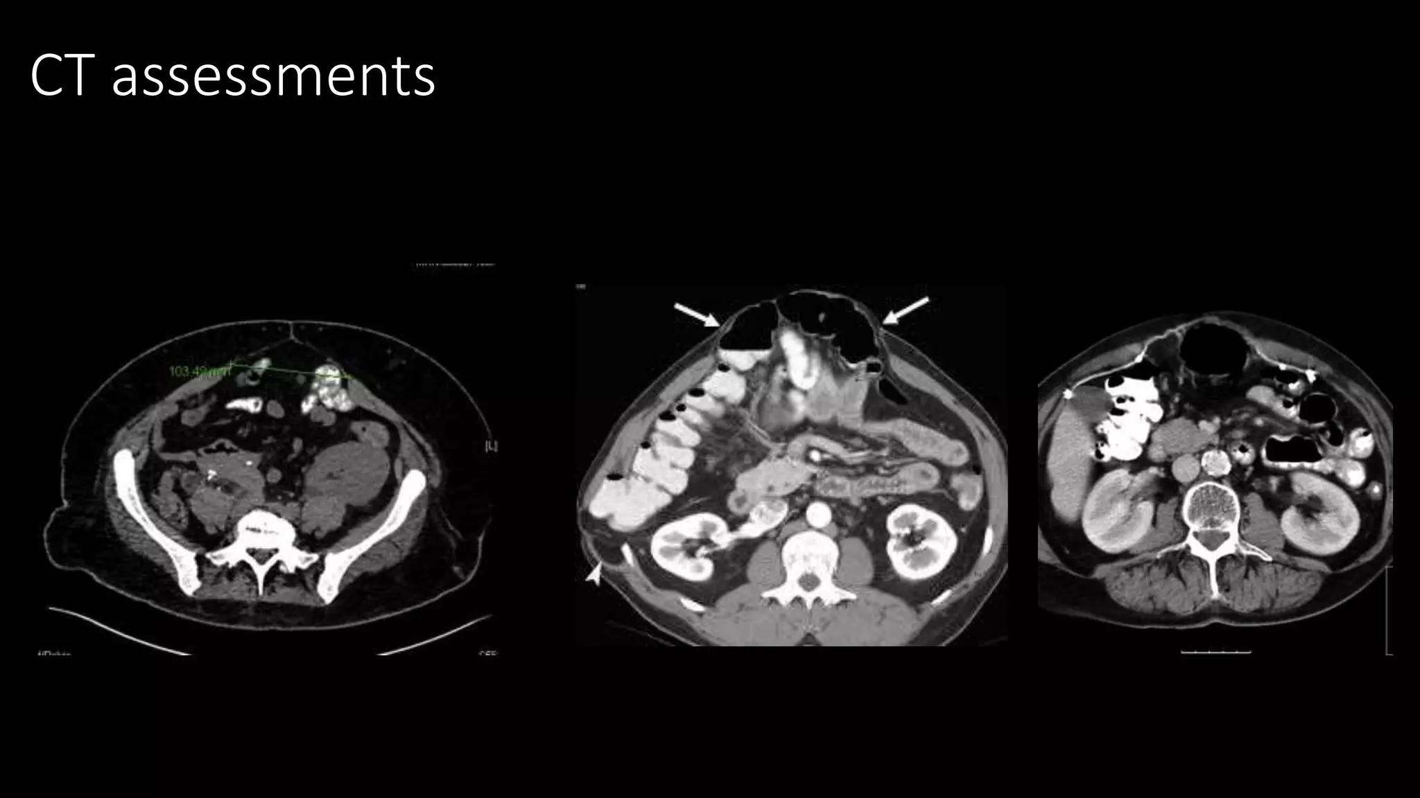 Component separation for ventral hernias prof. ahm shamsul alam | PPTX