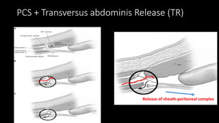 PCS + Transversus abdominis Release (TR)
Release of sheath-peritoneal complex
 