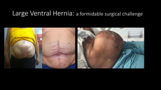 Large Ventral Hernia: a formidable surgical challenge
 