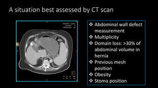 A situation best assessed by CT scan
 Abdominal wall defect
measurement
 Multiplicity
 Domain loss: >30% of
abdominal volume in
hernia
 Previous mesh
position
 Obesity
 Stoma position
 