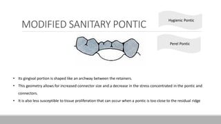 MODIFIED SANITARY PONTIC
Hygienic Pontic
• Its gingival portion is shaped like an archway between the retainers.
• This geometry allows for increased connector size and a decrease in the stress concentrated in the pontic and
connectors.
• It is also less susceptible to tissue proliferation that can occur when a pontic is too close to the residual ridge
Perel Pontic
 
