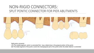 NON-RIGID CONNECTORS:
SPLIT PONTIC CONNECTOR FOR PIER ABUTMENTS
Split pontic connector
( A) The medial segment, which is cemented first , has a distal shoe in the gingival portion of the pontic
(B) The distal segment of the pontic covers the mesiogingival part of the pontic when the distal retainer is cemented
 
