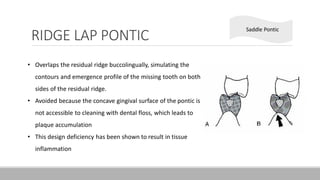 RIDGE LAP PONTIC
• Overlaps the residual ridge buccolingually, simulating the
contours and emergence profile of the missing tooth on both
sides of the residual ridge.
• Avoided because the concave gingival surface of the pontic is
not accessible to cleaning with dental floss, which leads to
plaque accumulation
• This design deficiency has been shown to result in tissue
inflammation
Saddle Pontic
 