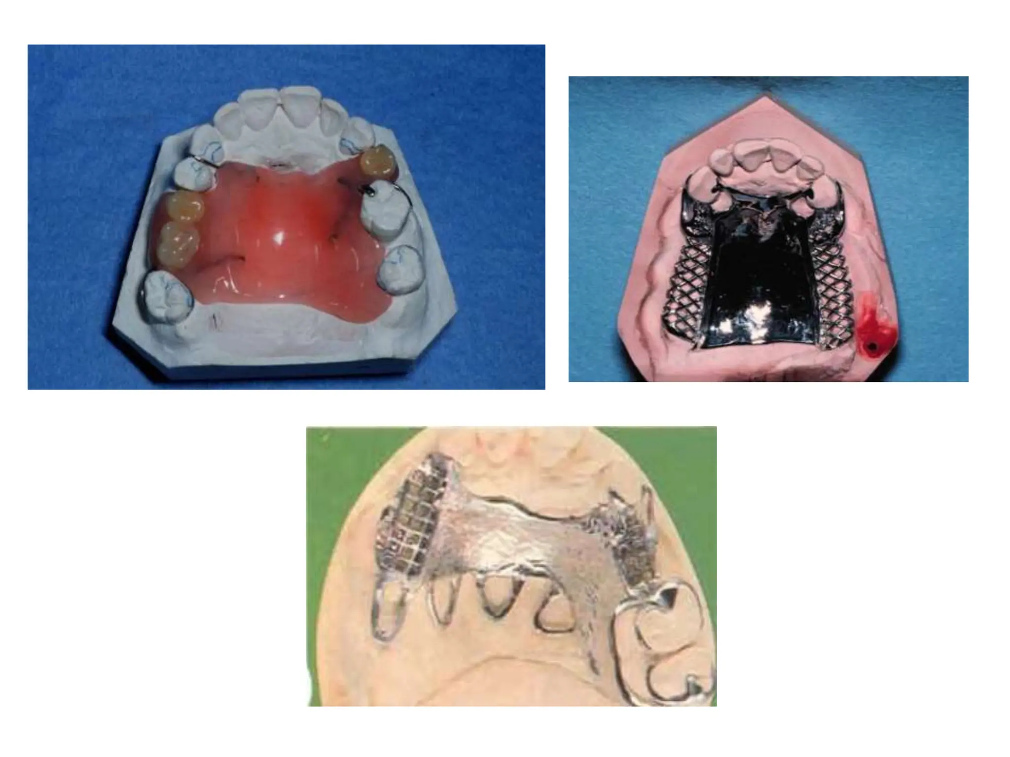 components of rpd.ppt