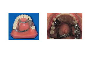 components of rpd.ppt