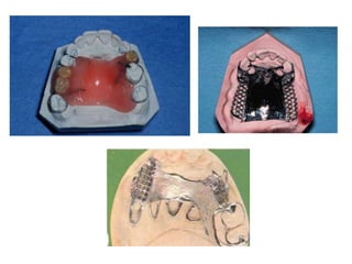 Thermoplastic Rpd components of rpd.ppt