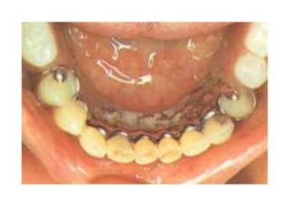 Tooth Lrpd components of rpd.ppt