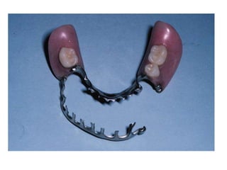 Resin Rest Rpd components of rpd.ppt
