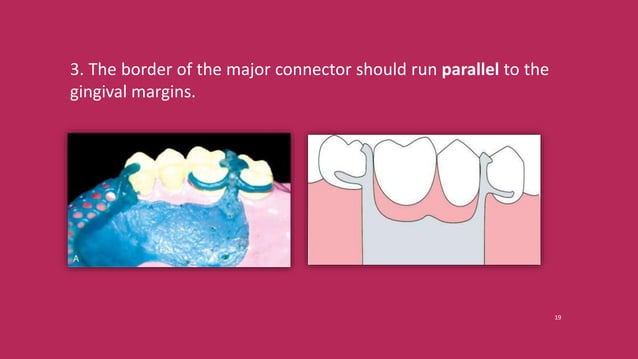 Split Major Connector Rpd Components of RPD and Major connectors_Dr Shuchi Jain.pptx