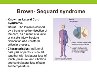 Brown- Sequard syndrome
• Known as Lateral Cord
Syndrome.
• Cause: The lesion is caused
by a transverse hemisection of
the cord, as a result of a knife
or missile injury, fracture
dislocation of a unilateral
articular process.
• Characteristics: Ipsilateral
paralysis or paresis is noted,
together with ipsilateral loss of
touch, pressure, and vibration
and contralateral loss of pain
and temperature.
 