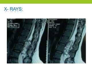 X- RAYS:
 