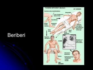 Beriberi
 