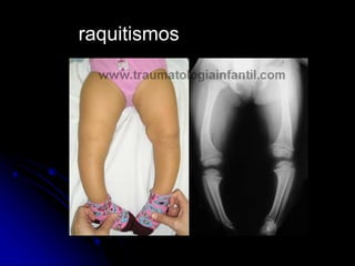 raquitismos
 