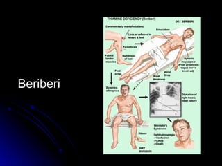 Beriberi
 