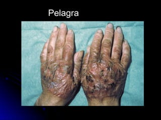 Pelagra
 
