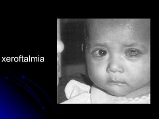 xeroftalmia
 