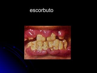 escorbuto
 