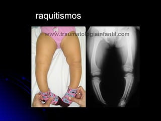 raquitismos
 
