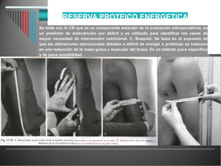 RESERVA PROTEICO ENERGETICA
del
Fig. 17-10. A. Medición punto medio entre la apófisis acromion
Medición de la circunferencia del
del hombro y el olécranon en el codo. B, Señalamiento del punto
brazo en centímetros en el punto medio.
Se mide con la CB que es un componente estándar de la evaluación antropométrica, es
un predictor de malnutrición por déficit y es utilizado para identificar los casos de
mayor necesidad de intervención nutricional. C. Braquial: Se basa en el supuesto de
que las alteraciones estructurales debidas a déficit de energía o proteínas se traducen
en una reducción de la masa grasa y muscular del brazo. Es un método poco específico
y de poca sensibilidad.
 