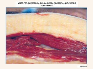 VISTA PER-OPERATORIA DEL LA GRASA ABDOMINAL DEL TEJIDO
SUBCUTANEO
Figura 13
 