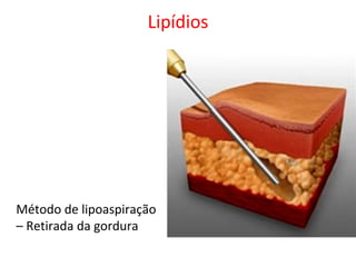 Lipídios
Método de lipoaspiração
– Retirada da gordura
 