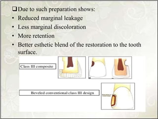 Due to such preparation shows:
• Reduced marginal leakage
• Less marginal discoloration
• More retention
• Better esthetic blend of the restoration to the tooth
surface.
 