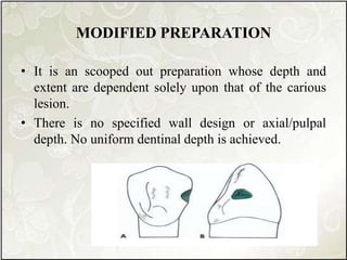 MODIFIED PREPARATION
• It is an scooped out preparation whose depth and
extent are dependent solely upon that of the carious
lesion.
• There is no specified wall design or axial/pulpal
depth. No uniform dentinal depth is achieved.
 