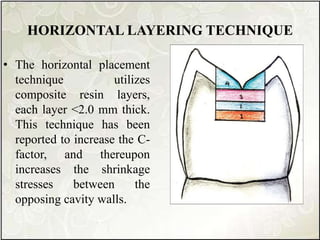 HORIZONTAL LAYERING TECHNIQUE
• The horizontal placement
technique utilizes
composite resin layers,
each layer <2.0 mm thick.
This technique has been
reported to increase the C-
factor, and thereupon
increases the shrinkage
stresses between the
opposing cavity walls.
 