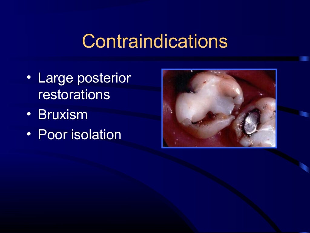 Composite and acid etching