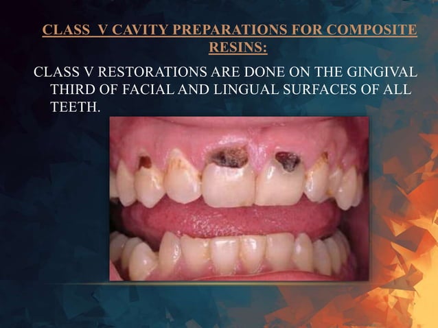 anterior composite restoration | PPTX