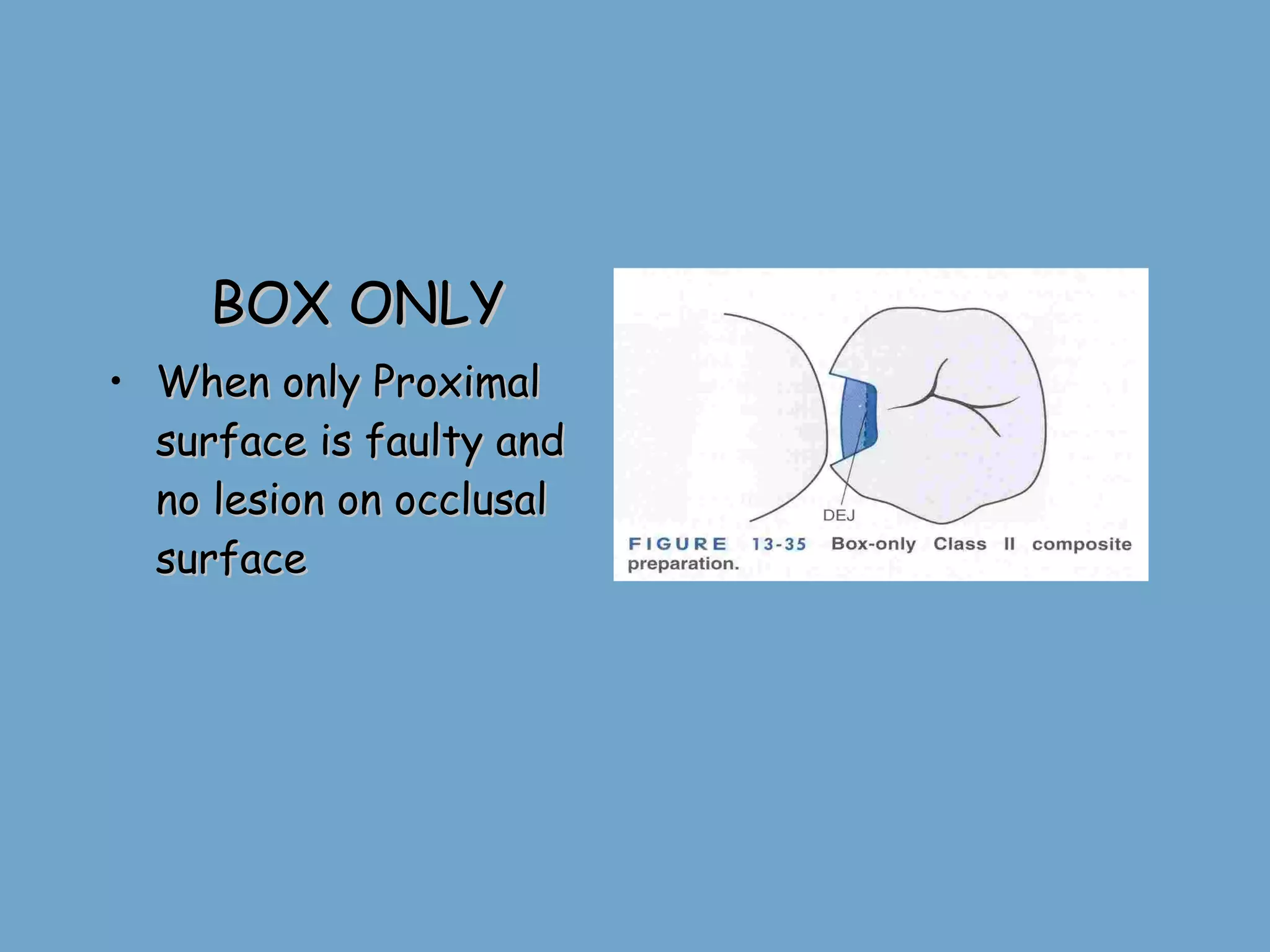 BOX ONLY When only Proximal surface is faulty and no lesion on occlusal surface 
