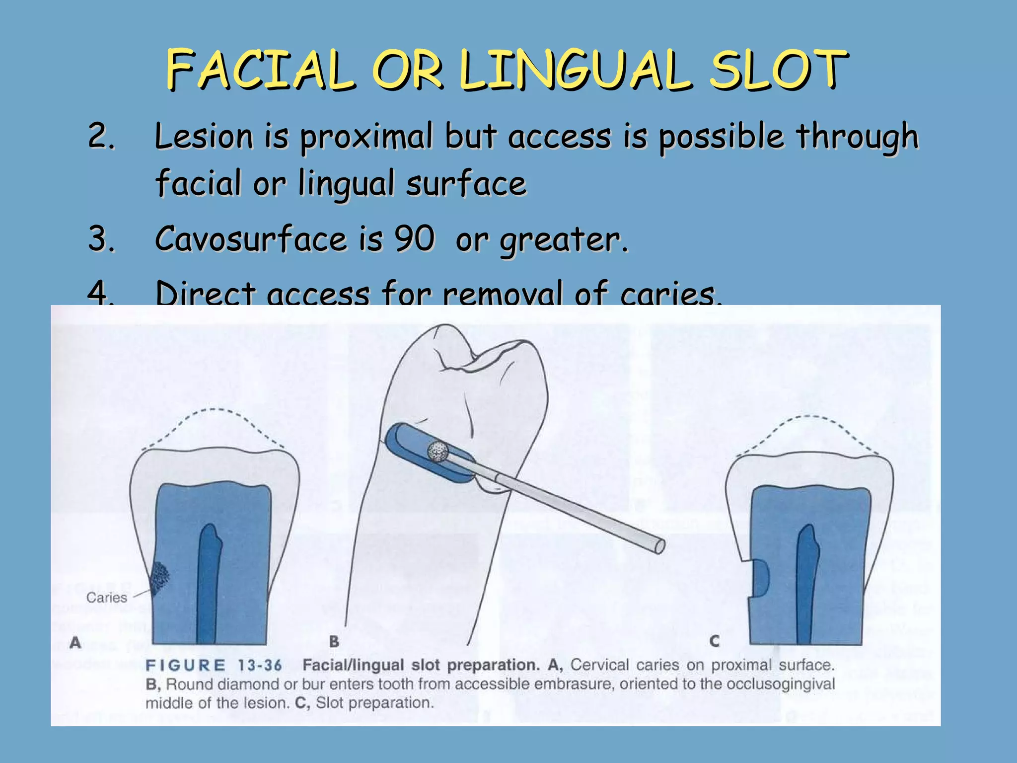 FACIAL OR LINGUAL SLOT Lesion is proximal but access is possible through facial or lingual surface Cavosurface is 90  or greater. Direct access for removal of caries. 