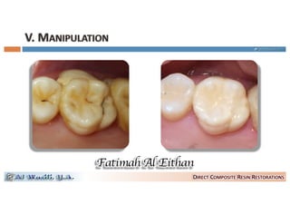 Composite resin artistry