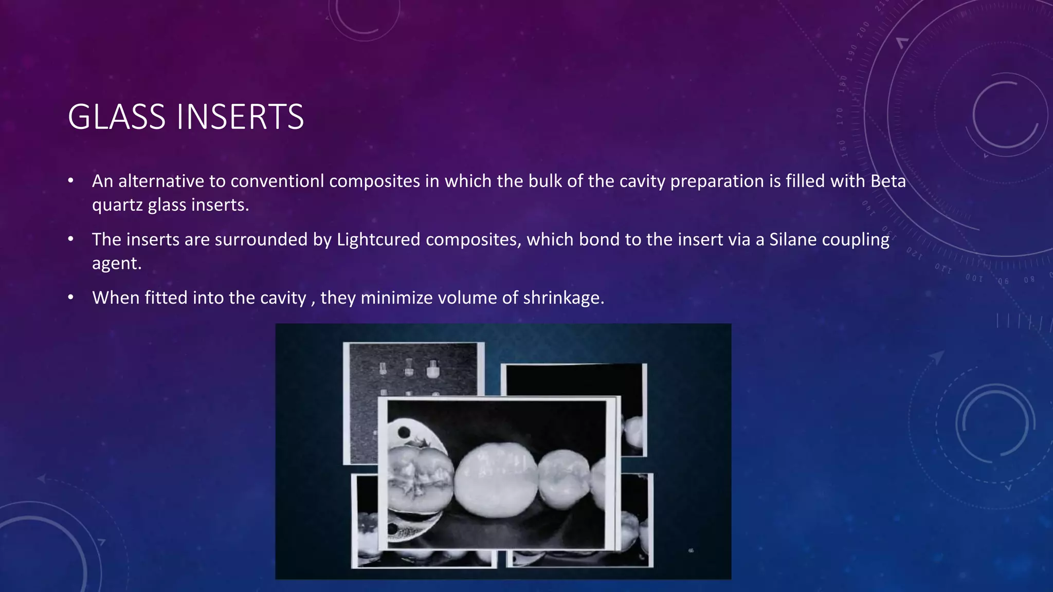 GLASS INSERTS
• An alternative to conventionl composites in which the bulk of the cavity preparation is filled with Beta
quartz glass inserts.
• The inserts are surrounded by Lightcured composites, which bond to the insert via a Silane coupling
agent.
• When fitted into the cavity , they minimize volume of shrinkage.
 