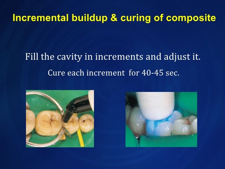 Composite resin technique
