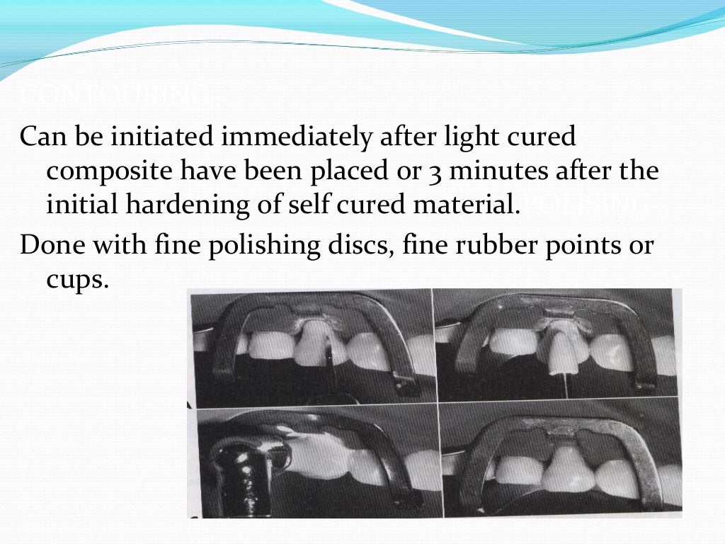 Composite restoration