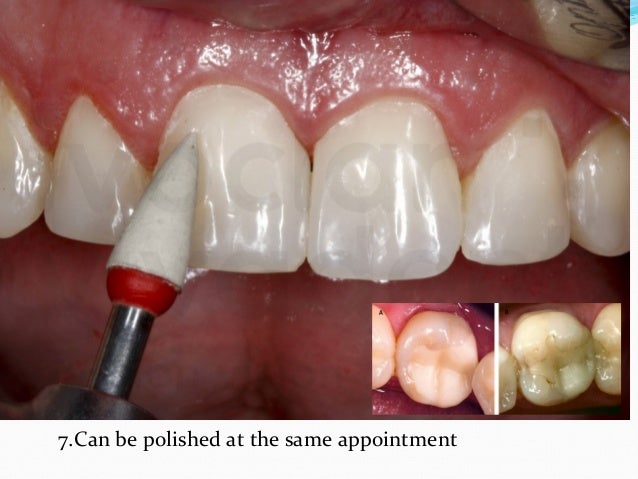 composite restoration composite restoration