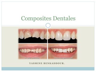 Y A S M I N E B E N K A D D O U R .
Composites Dentales
 