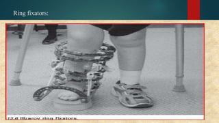 Ring fixators:
 