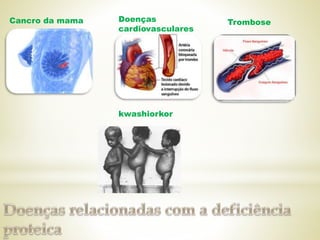 Cancro da mama Doenças
cardiovasculares
Trombose
kwashiorkor
 